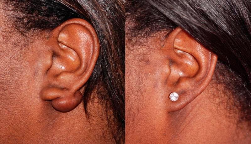 Earlobe Repair Before and After | Weber Facial Plastic Surgery