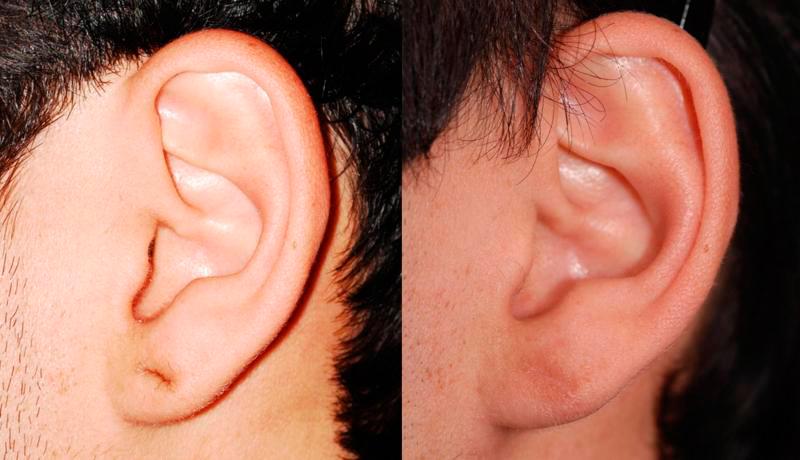 Earlobe Repair Before and After | Weber Facial Plastic Surgery