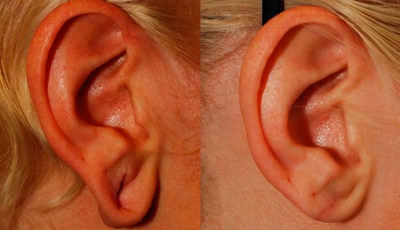 Earlobe Repair Before and After | Weber Facial Plastic Surgery