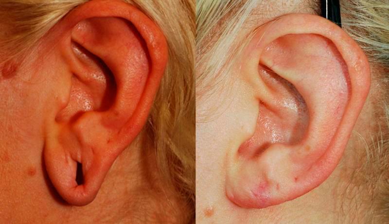 Earlobe Repair Before and After | Weber Facial Plastic Surgery