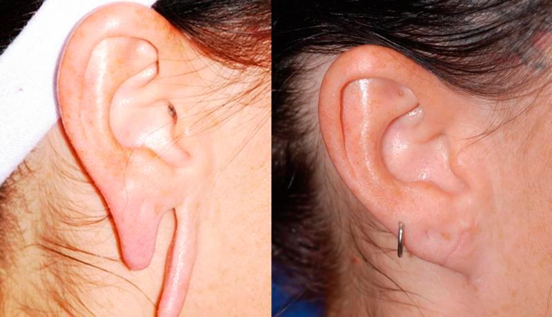 Earlobe Repair Before and After | Weber Facial Plastic Surgery
