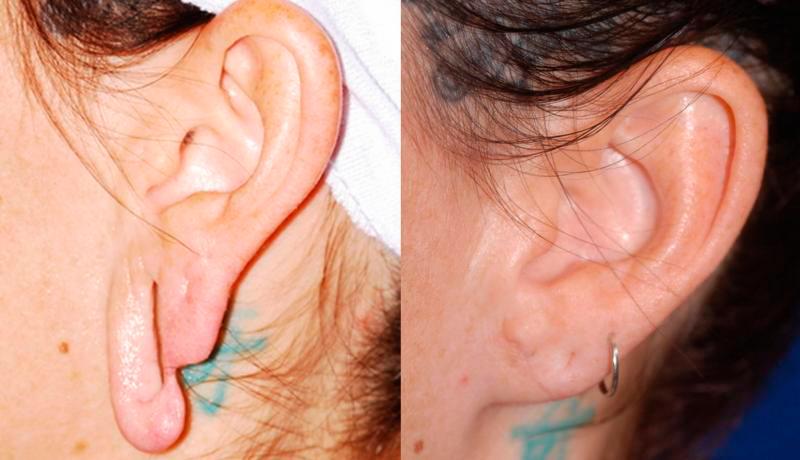 Earlobe Repair Before and After | Weber Facial Plastic Surgery