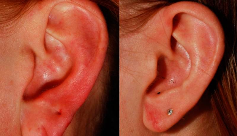 Earlobe Repair Before and After | Weber Facial Plastic Surgery
