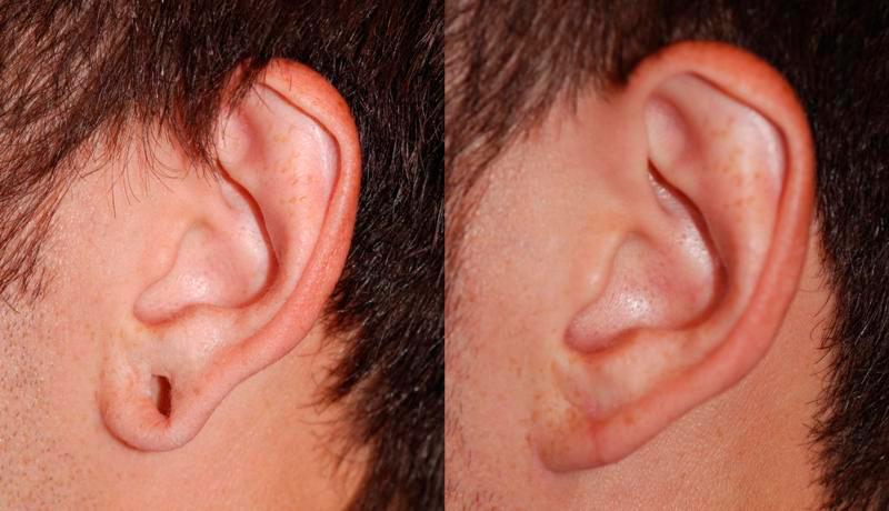 Earlobe Repair Before and After | Weber Facial Plastic Surgery