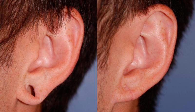 Earlobe Repair Before and After | Weber Facial Plastic Surgery