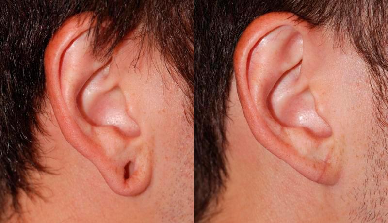 Earlobe Repair Before and After | Weber Facial Plastic Surgery