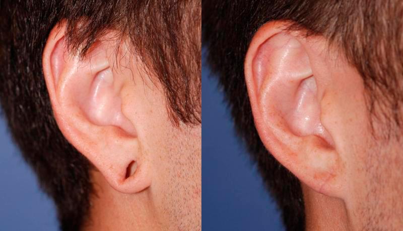 Earlobe Repair Before and After | Weber Facial Plastic Surgery