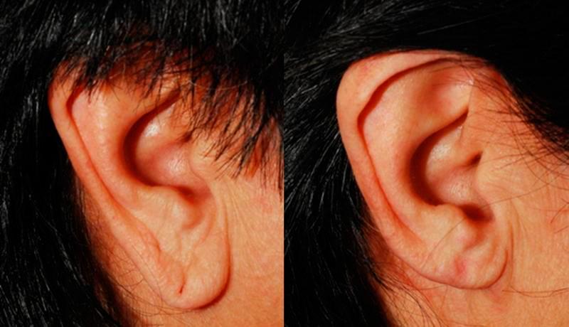 Earlobe Repair Before and After | Weber Facial Plastic Surgery