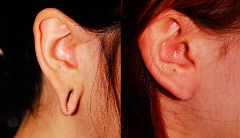 Earlobe Repair Before and After | Weber Facial Plastic Surgery