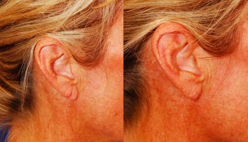Earlobe Repair Before and After | Weber Facial Plastic Surgery