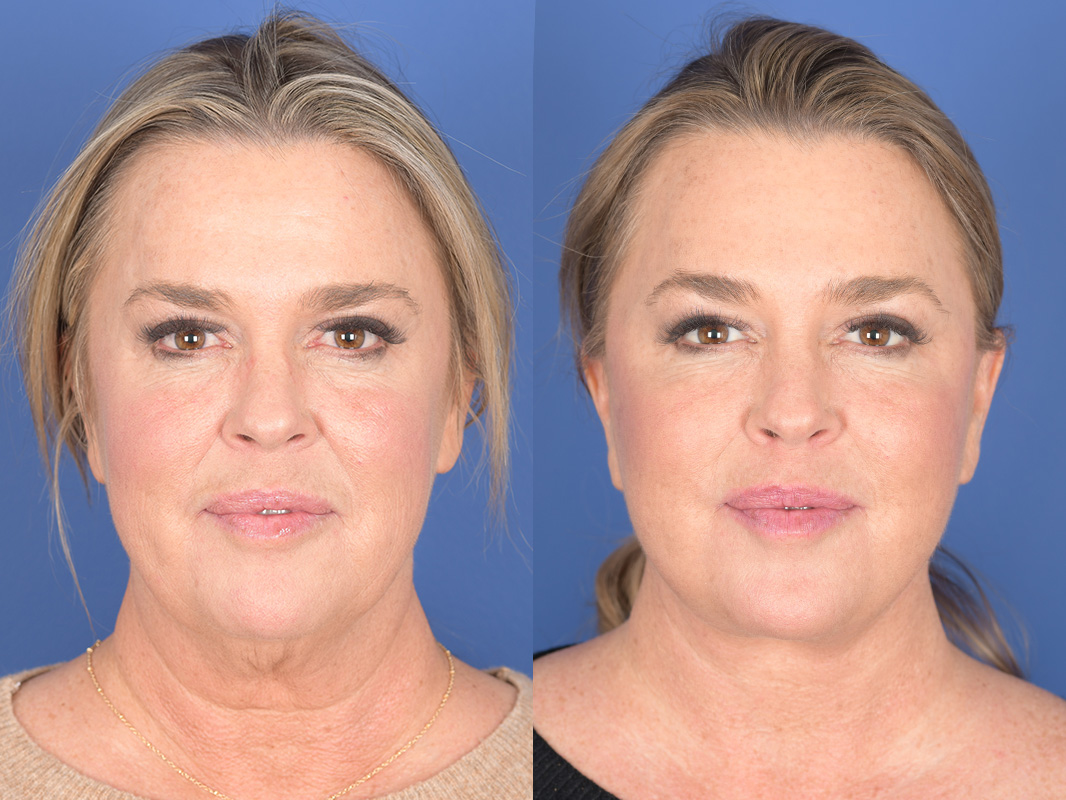 Facelift Before and After | Weber Facial Plastic Surgery