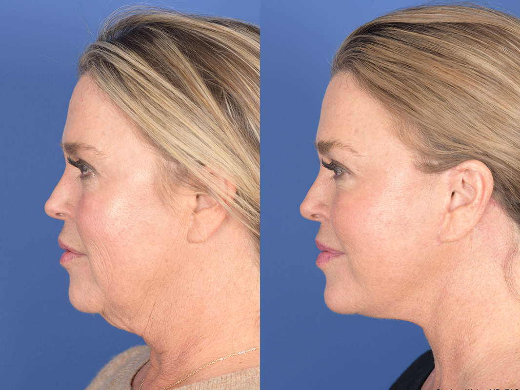 Facelift Before and After | Weber Facial Plastic Surgery