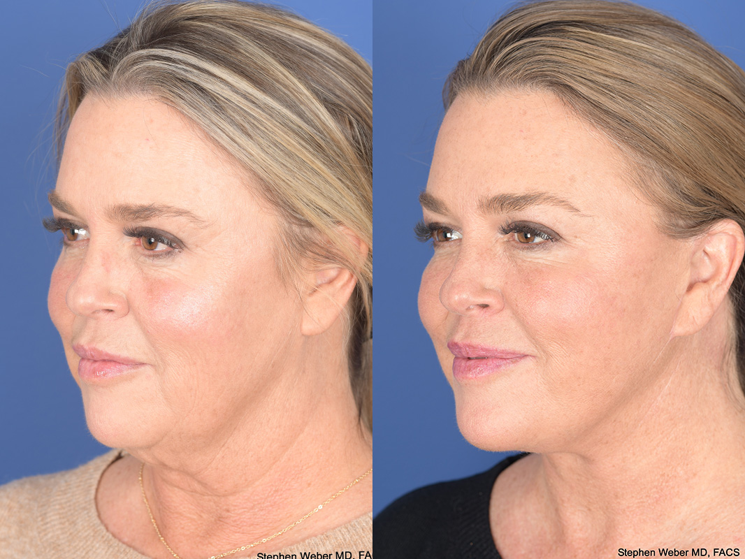 Facelift Before and After | Weber Facial Plastic Surgery
