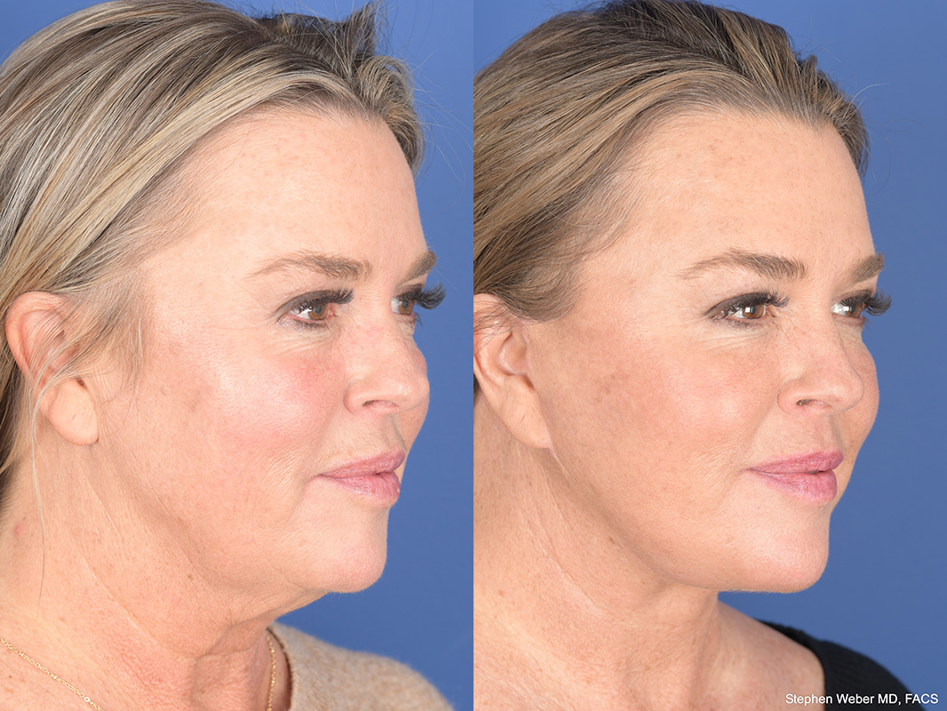 Facelift Before and After | Weber Facial Plastic Surgery