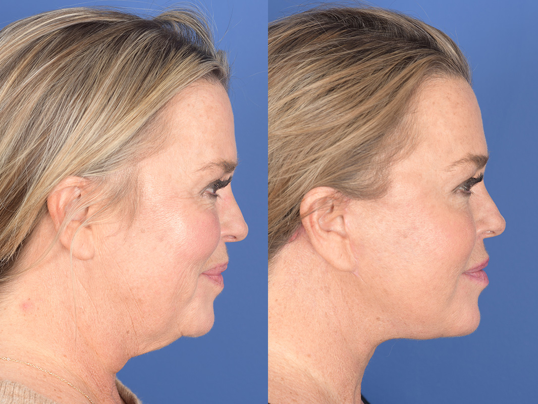 Facelift Before and After | Weber Facial Plastic Surgery