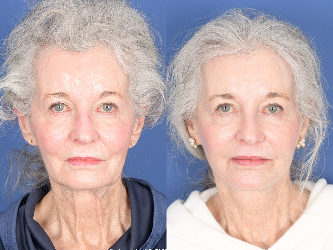 Facelift Before and After | Weber Facial Plastic Surgery