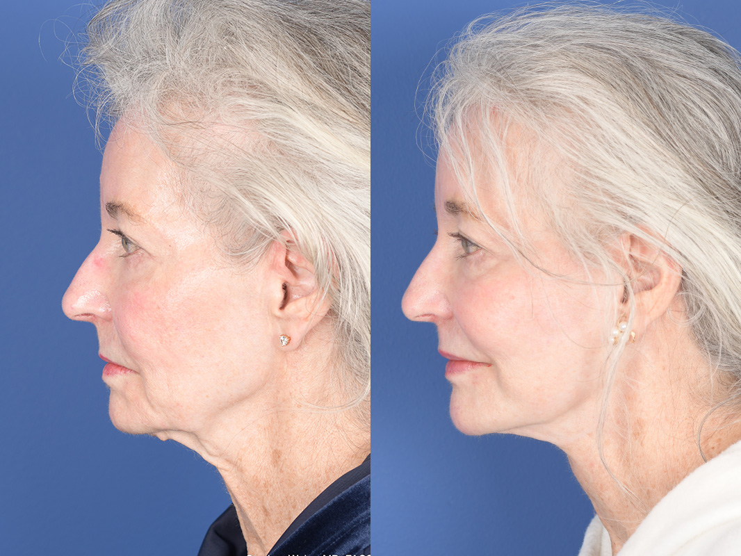 Facelift Before and After | Weber Facial Plastic Surgery