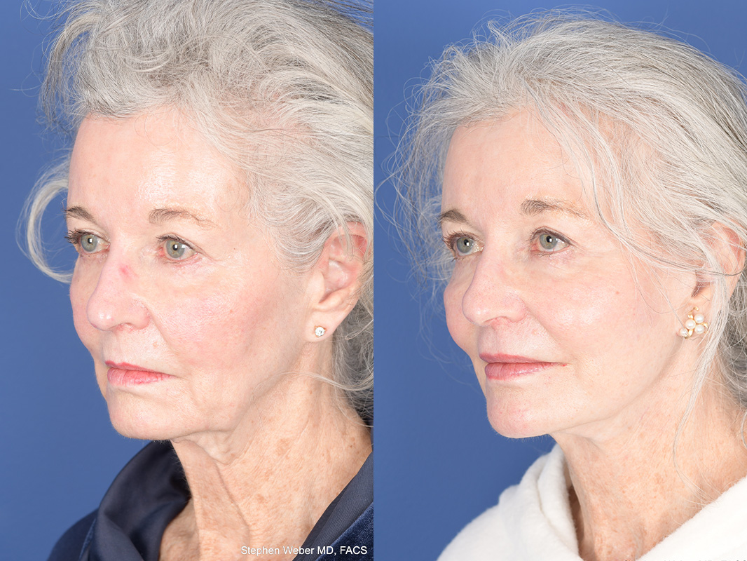 Facelift Before and After | Weber Facial Plastic Surgery