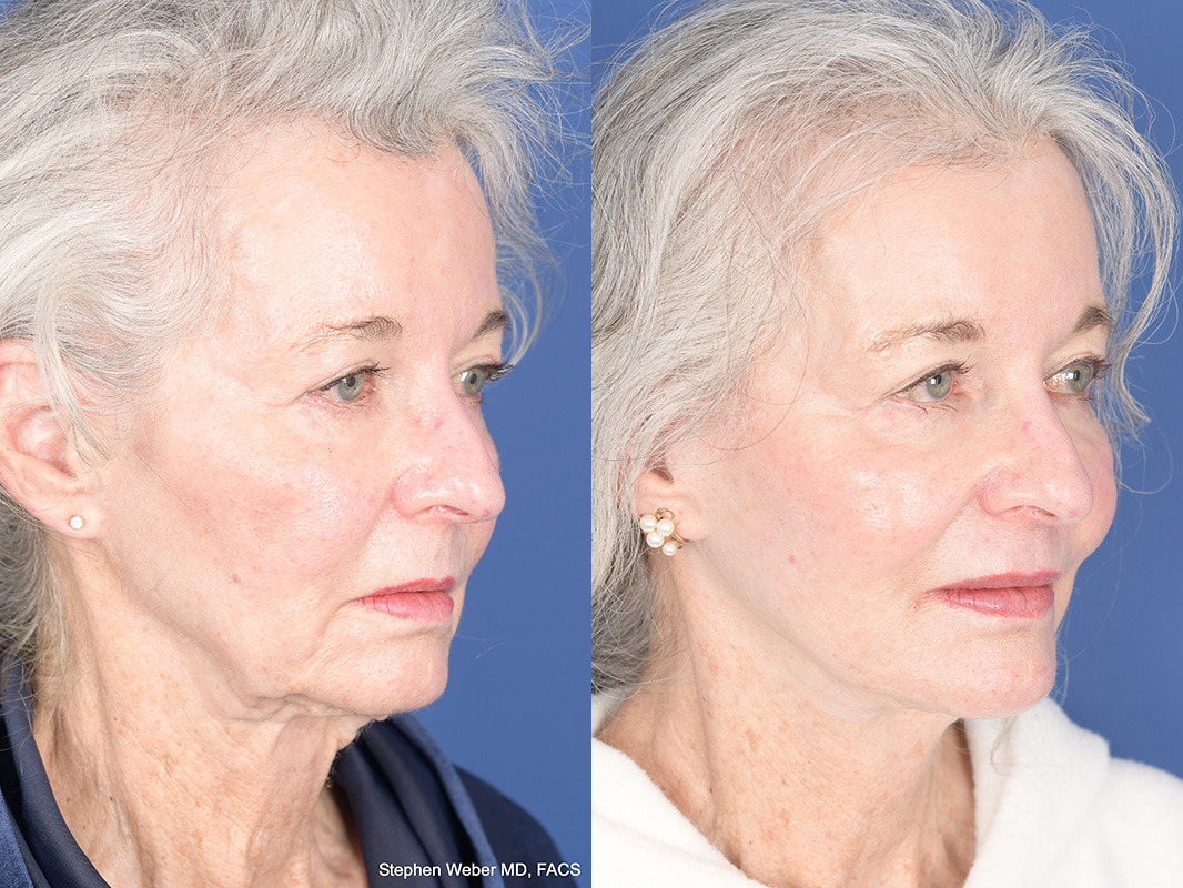 Facelift Before and After | Weber Facial Plastic Surgery