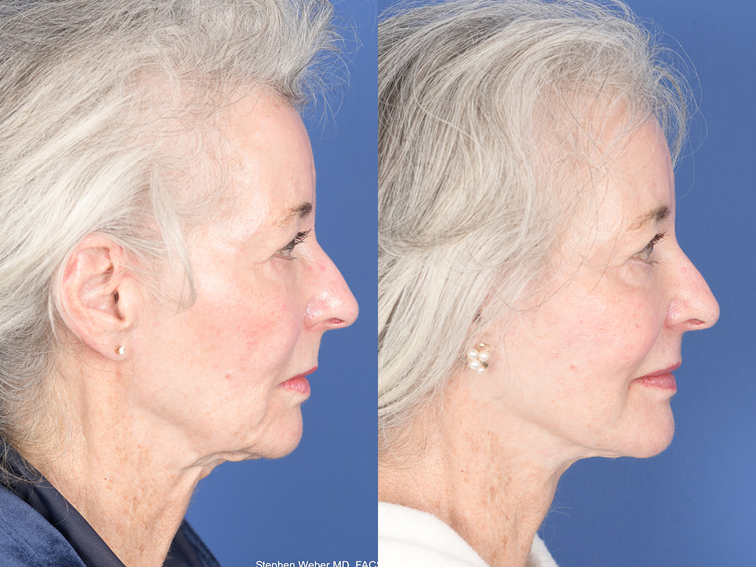 Facelift Before and After | Weber Facial Plastic Surgery