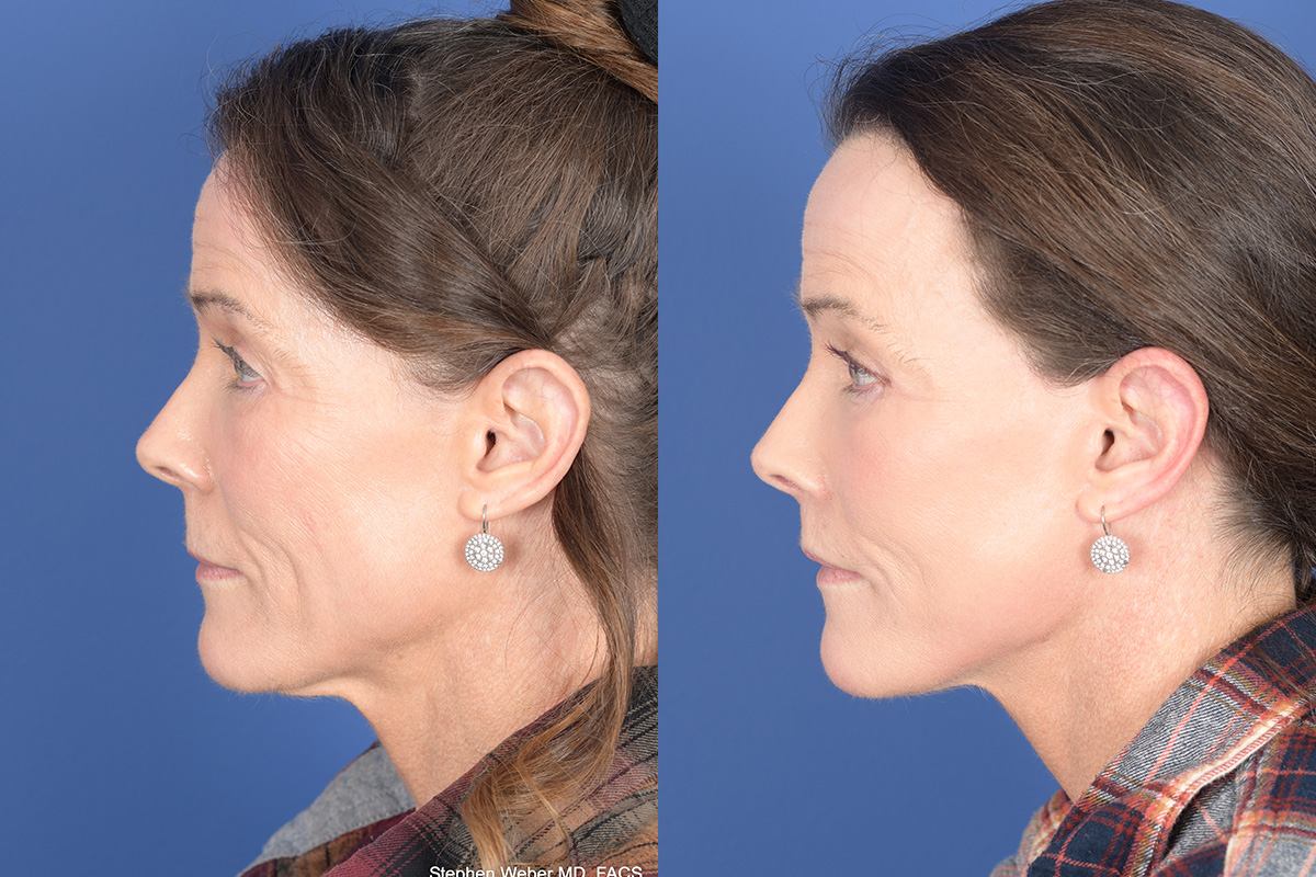 Facelift Before and After | Weber Facial Plastic Surgery