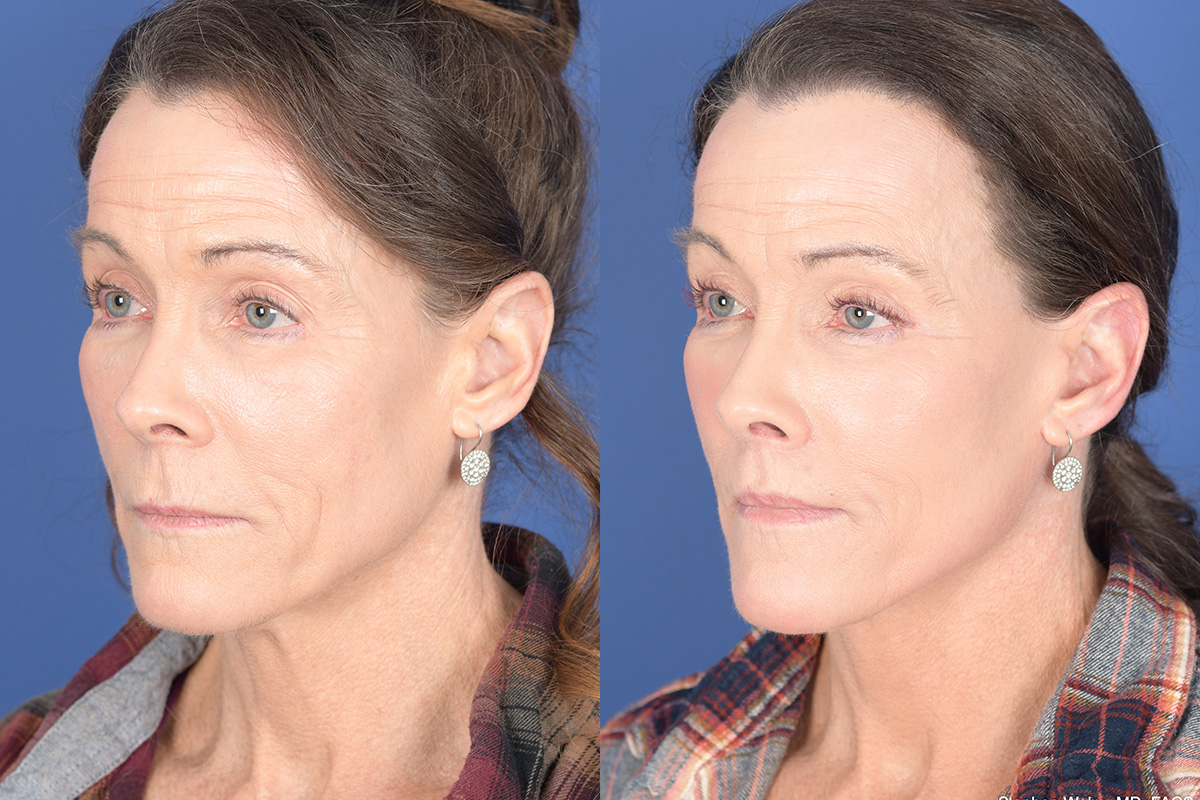 Facelift Before and After | Weber Facial Plastic Surgery
