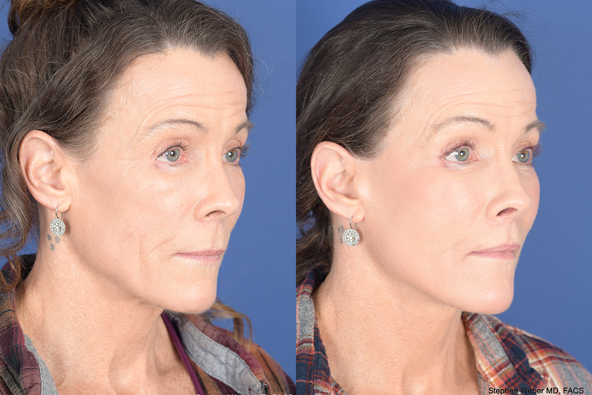 Facelift Before and After | Weber Facial Plastic Surgery