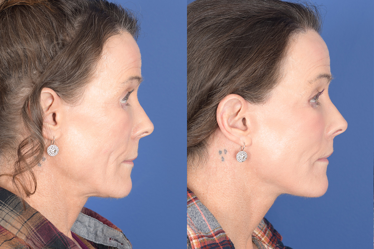 Facelift Before and After | Weber Facial Plastic Surgery