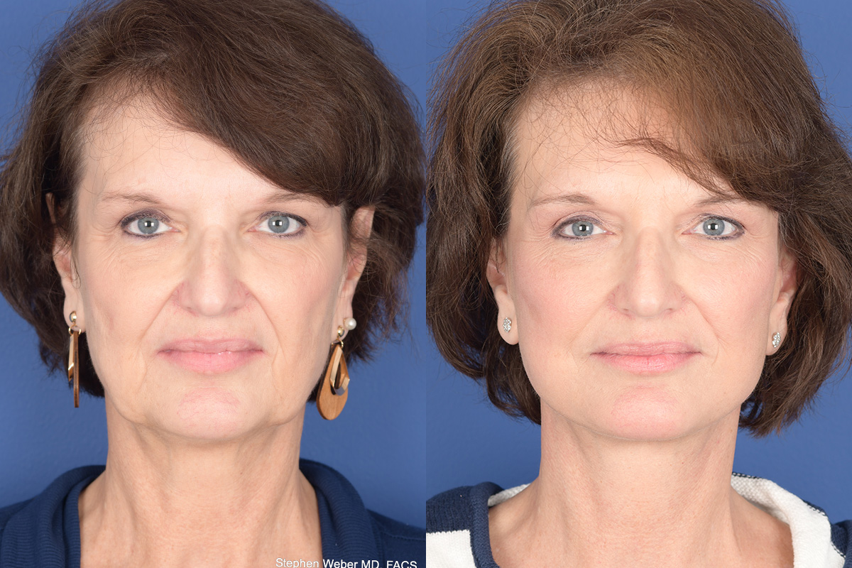 Facelift Before and After | Weber Facial Plastic Surgery