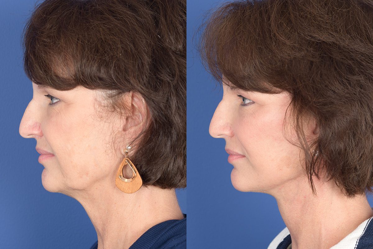 Facelift Before and After | Weber Facial Plastic Surgery
