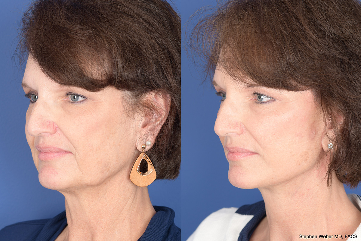 Facelift Before and After | Weber Facial Plastic Surgery