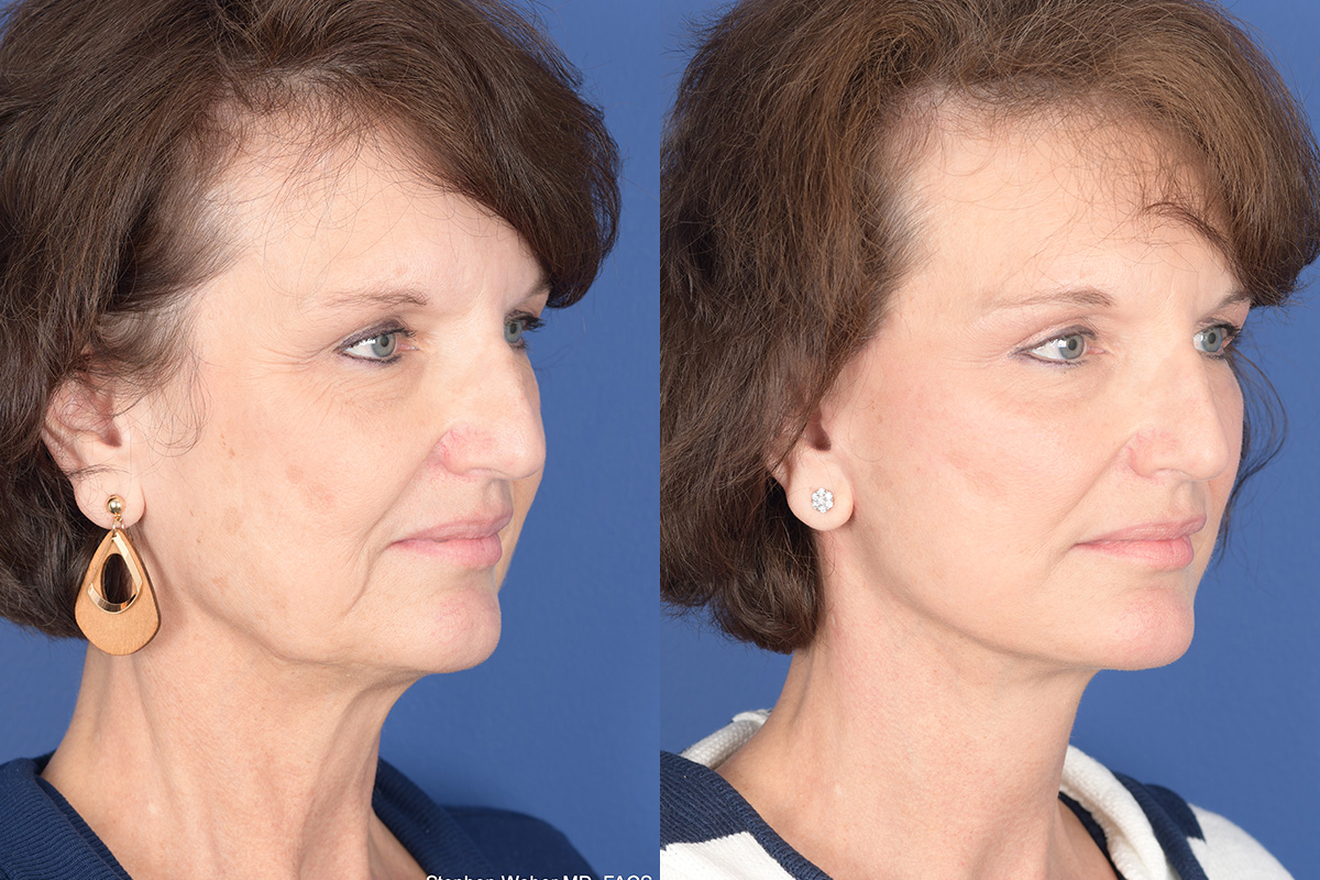 Facelift Before and After | Weber Facial Plastic Surgery