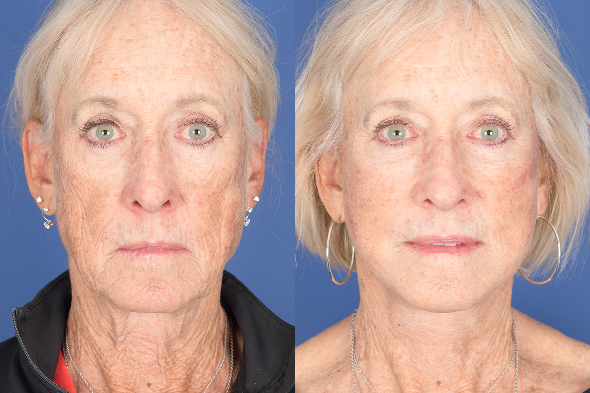 Facelift Before and After | Weber Facial Plastic Surgery