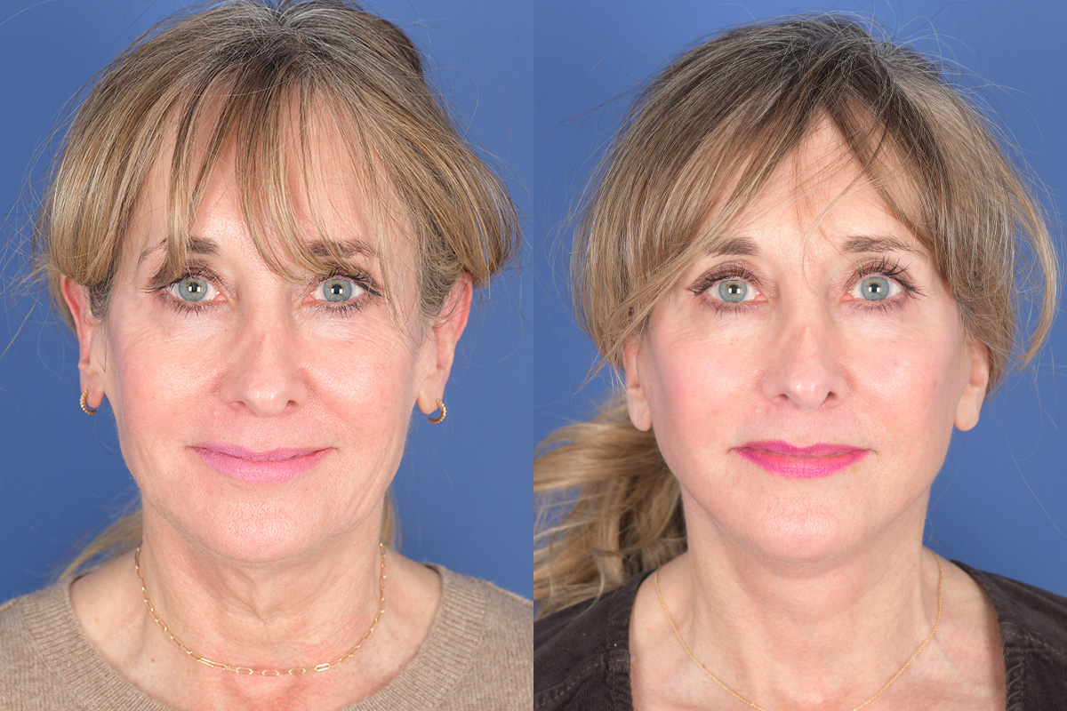 Facelift Before and After | Weber Facial Plastic Surgery