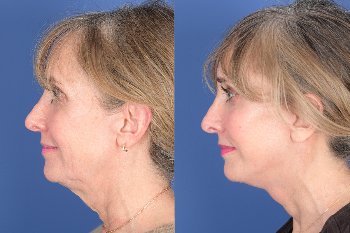 Facelift Before and After | Weber Facial Plastic Surgery