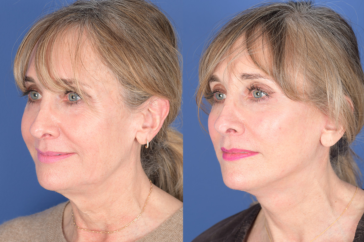 Facelift Before and After | Weber Facial Plastic Surgery