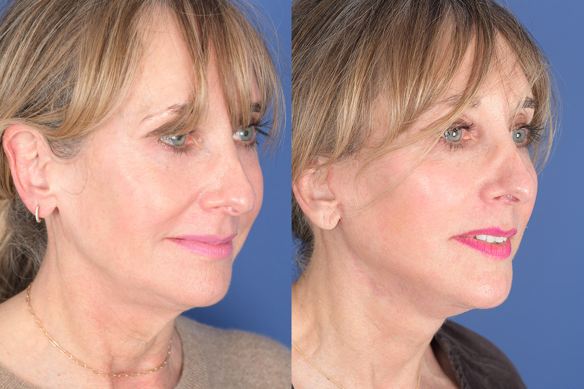 Facelift Before and After | Weber Facial Plastic Surgery