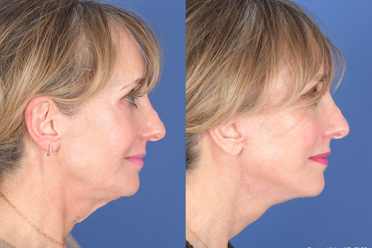 Facelift Before and After | Weber Facial Plastic Surgery