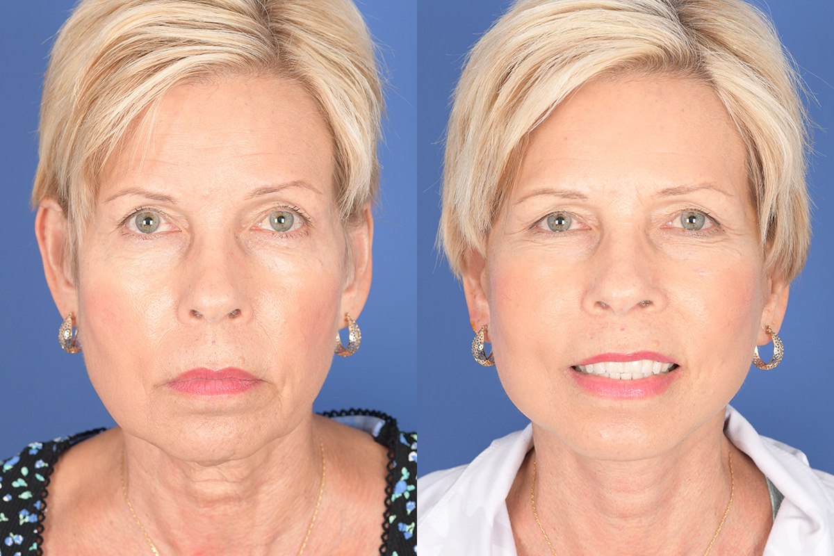 Facelift Before and After | Weber Facial Plastic Surgery