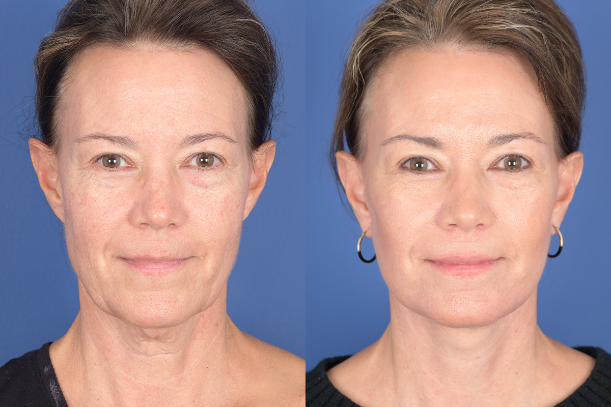 Facelift Before and After | Weber Facial Plastic Surgery