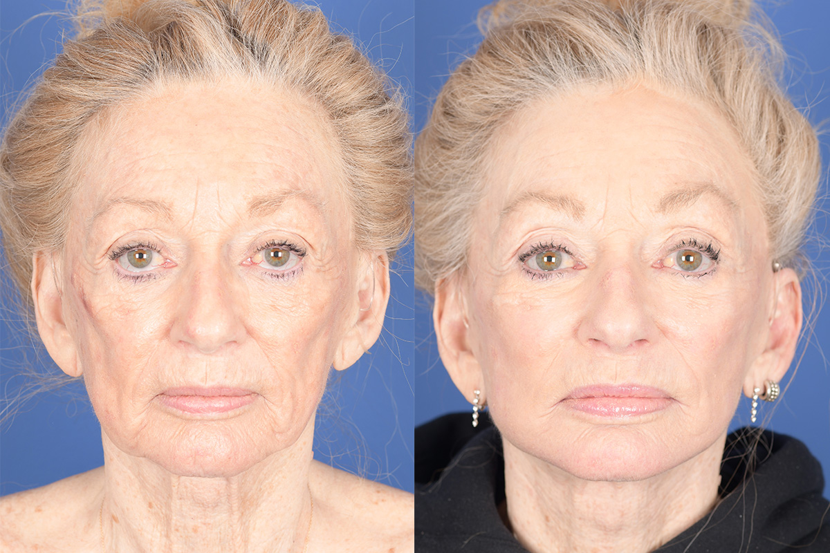 Facelift Before and After | Weber Facial Plastic Surgery