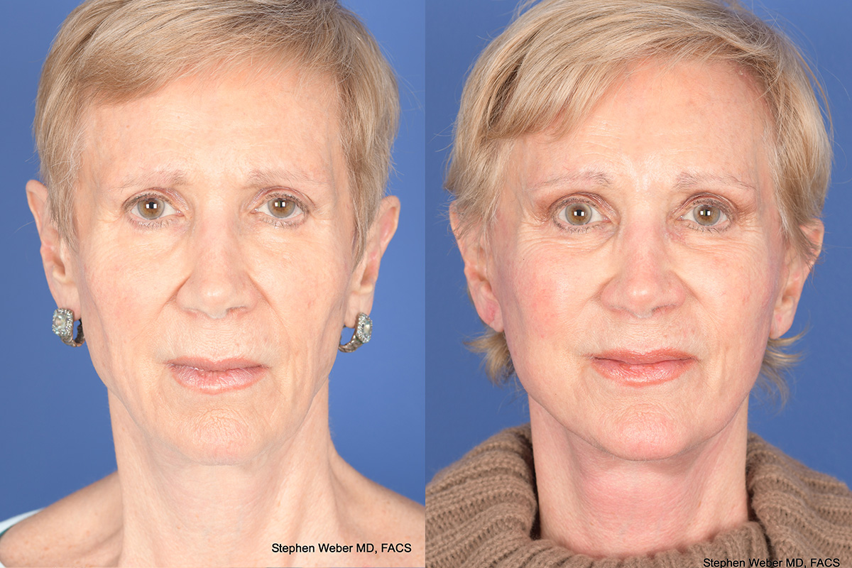 Facelift Before and After | Weber Facial Plastic Surgery
