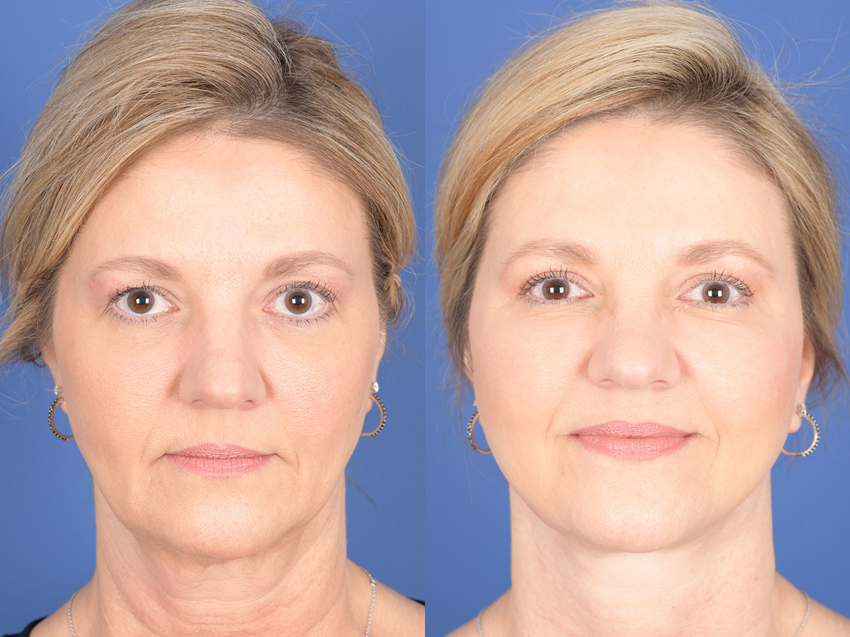 Facelift Before and After | Weber Facial Plastic Surgery