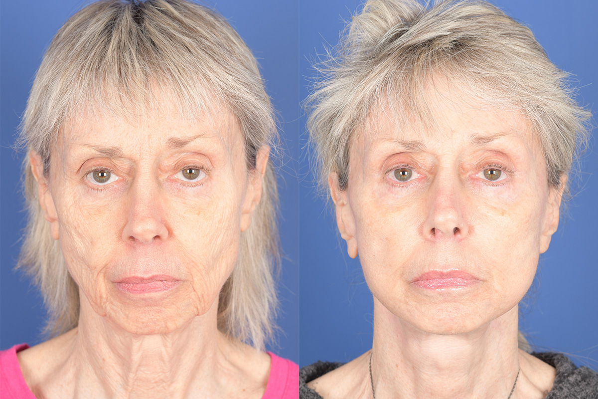 Facelift Before and After | Weber Facial Plastic Surgery
