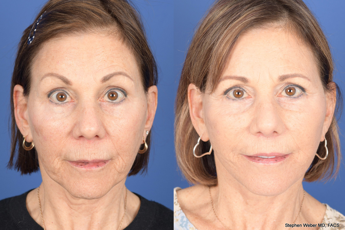 Facelift Before and After | Weber Facial Plastic Surgery