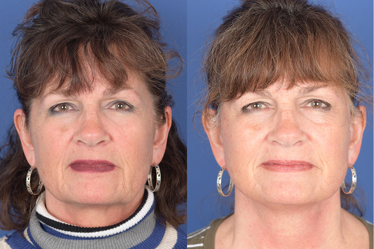 Facelift Before and After | Weber Facial Plastic Surgery