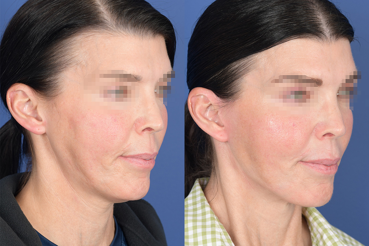 Facelift Before and After | Weber Facial Plastic Surgery