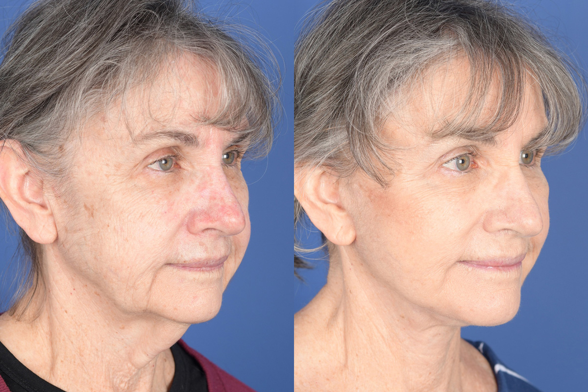 Facelift Before and After | Weber Facial Plastic Surgery