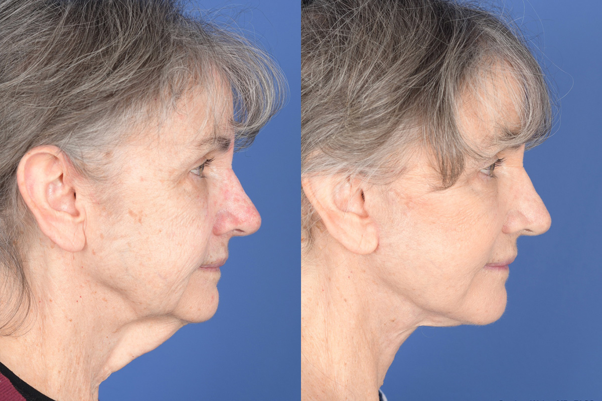 Facelift Before and After | Weber Facial Plastic Surgery