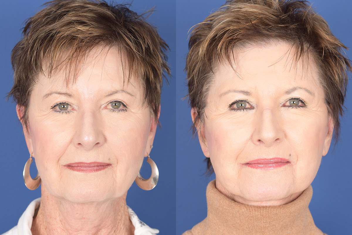 Facelift Before and After | Weber Facial Plastic Surgery
